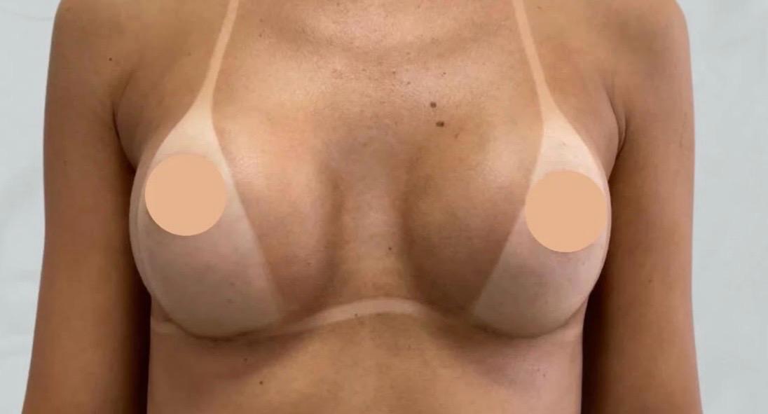 Prótese de Mama - Depois