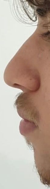 Rinoplastia - Antes