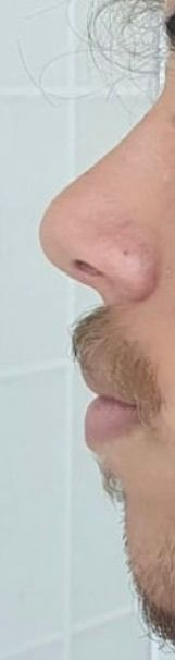 Rinoplastia - Depois